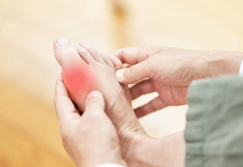 Các lưu ý để giảm axit uric và phòng chống bệnh gout