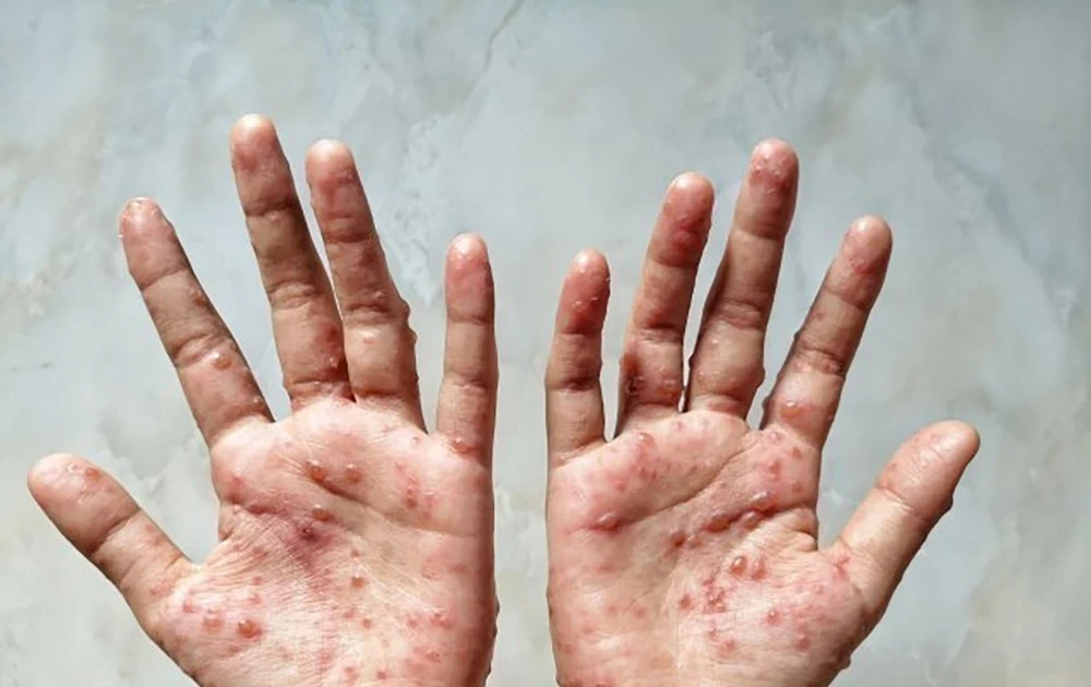 Số ca mắc bệnh đậu mùa khỉ ở Kenya tăng lên 31